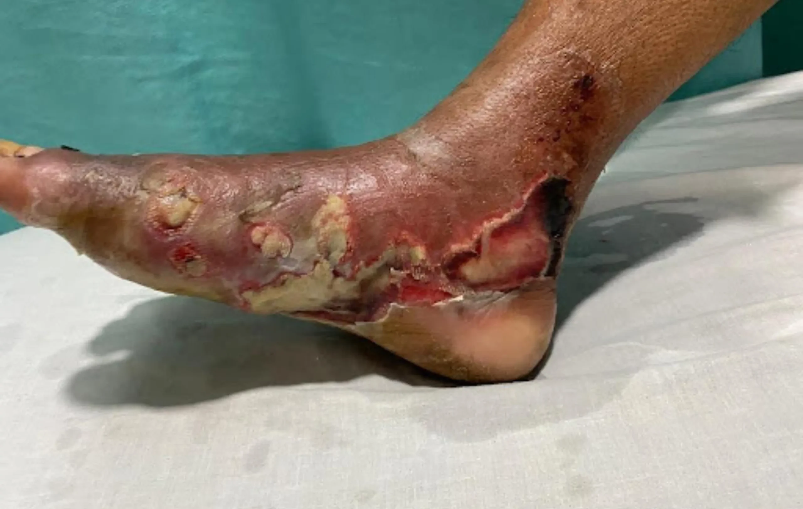 Varicose Vein Surgery in Lahore