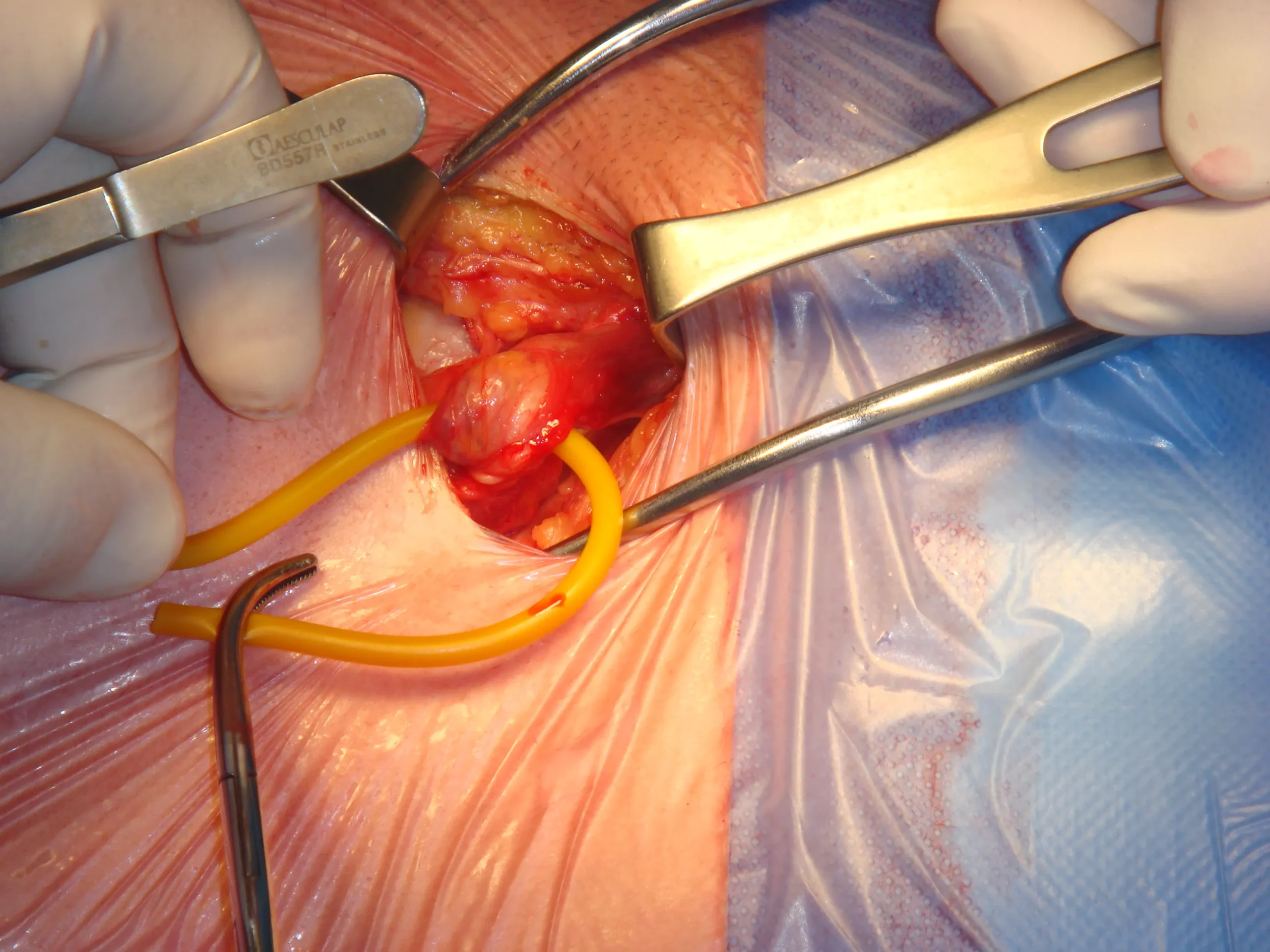 Surgical excision of breast lump procedure