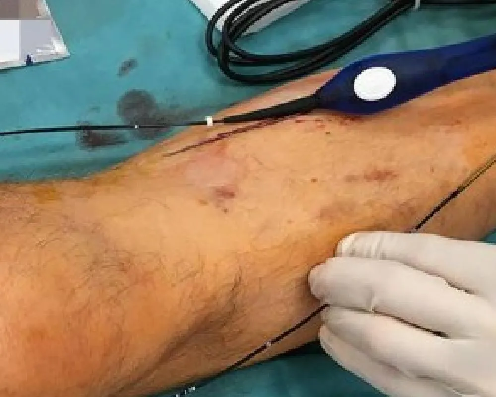 Laser fiber insertion for varicose veins treatment in leg
