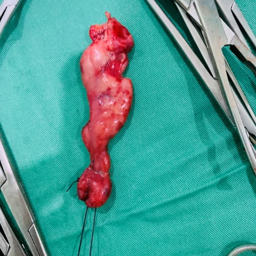 Surgically removed inflamed appendix specimen in Lahore