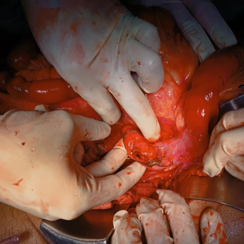 Advanced intestinal surgery procedure performed by expert surgeon in Lahore
