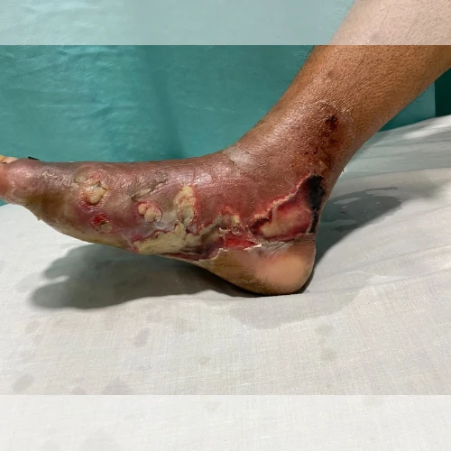 Severe infected foot wound and ulcer treatment in Lahore