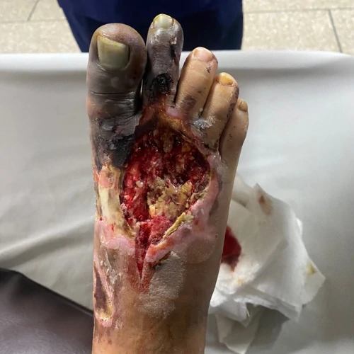 Severe diabetic foot ulcer and wound infection treatment in Lahore