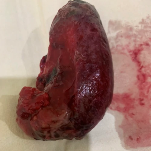 Surgically removed enlarged spleen specimen in Lahore