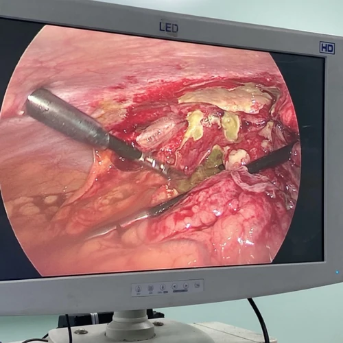 Laparoscopic gallbladder stone removal procedure in Lahore