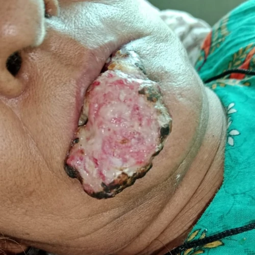 Advanced oral cancer tumor evaluation and surgical treatment in Lahore