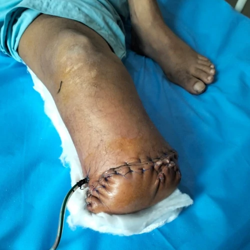 Post-operative below knee amputation surgical wound in Lahore
