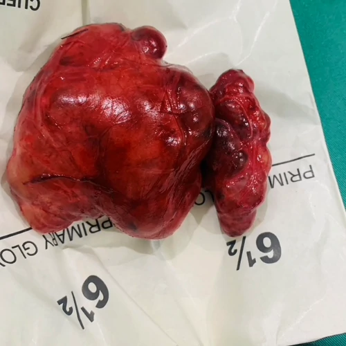 Surgically removed large abdominal tumor specimen in Lahore