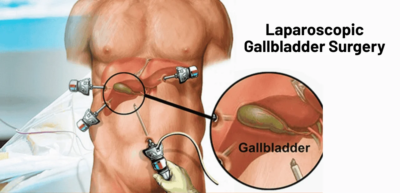 Laparoscopic Gallbladder Surgery