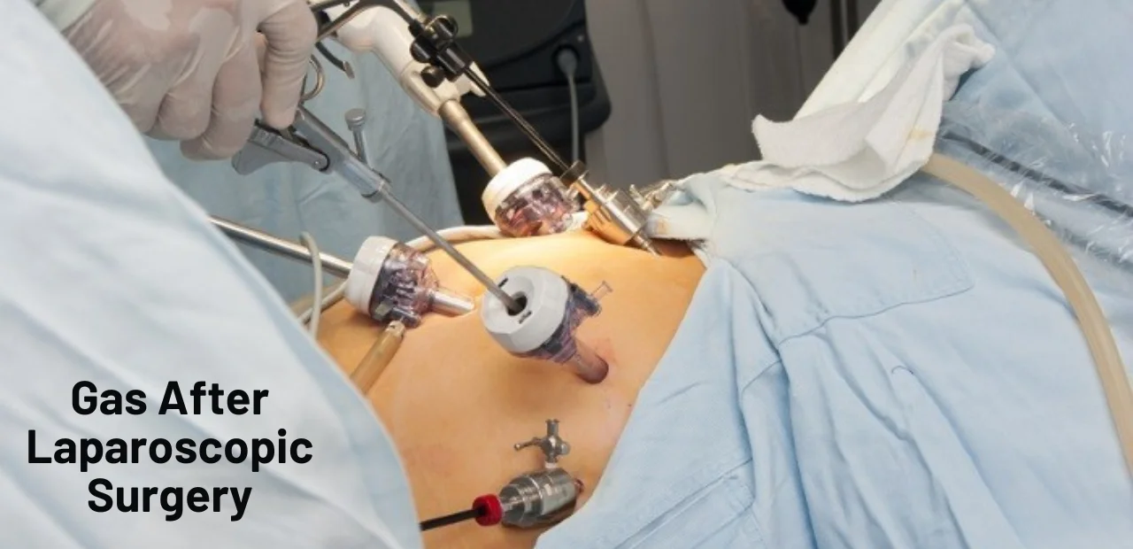 Gas After Laparoscopic Surgery: Causes and How to Get Relief 1 Gas After Laparoscopic Surgery