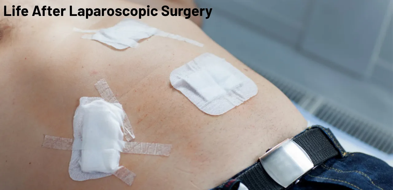 Life After Laparoscopic Surgery: When Can You Return to Normal Activities? 1 Life After Laparoscopic Surgery